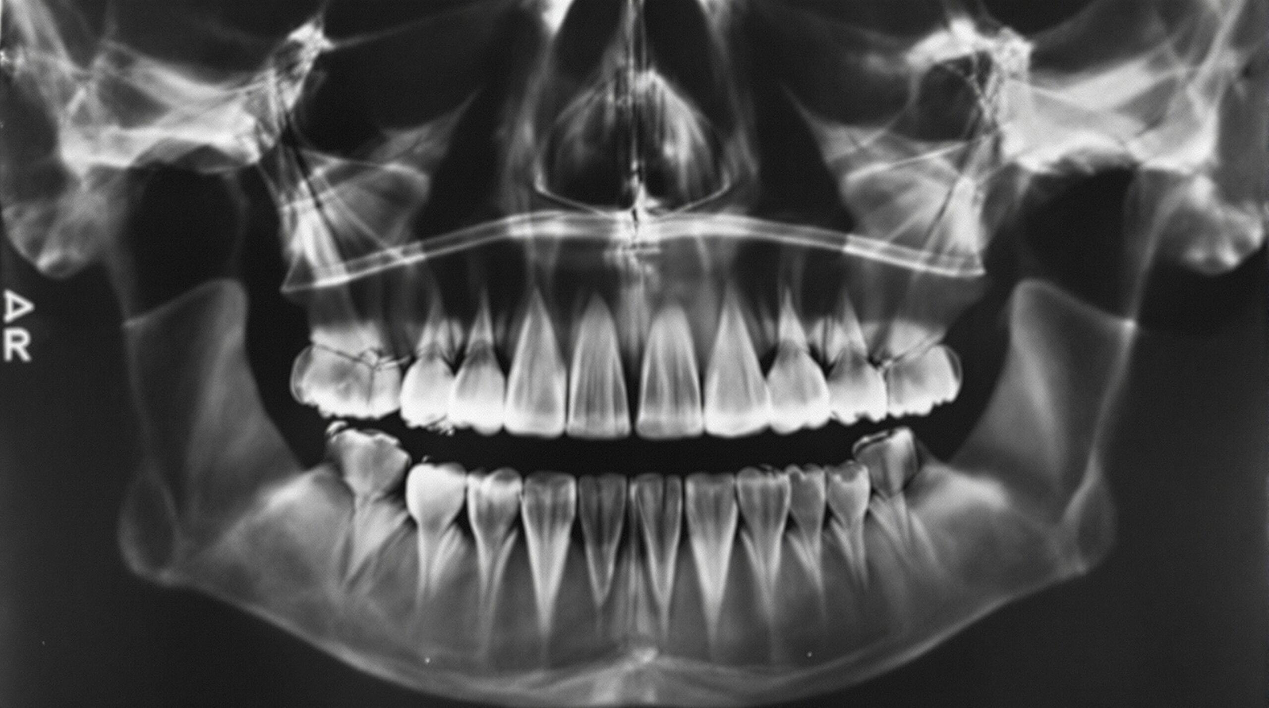 First dental X-ray photograph, 1896