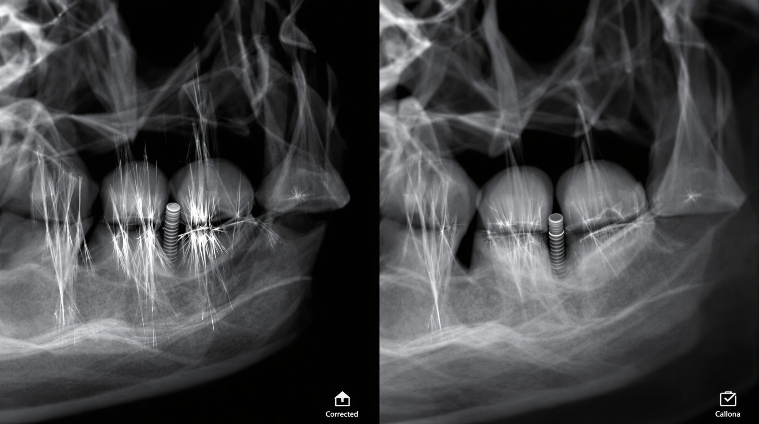 Comparison showing metal artifacts before and after correction