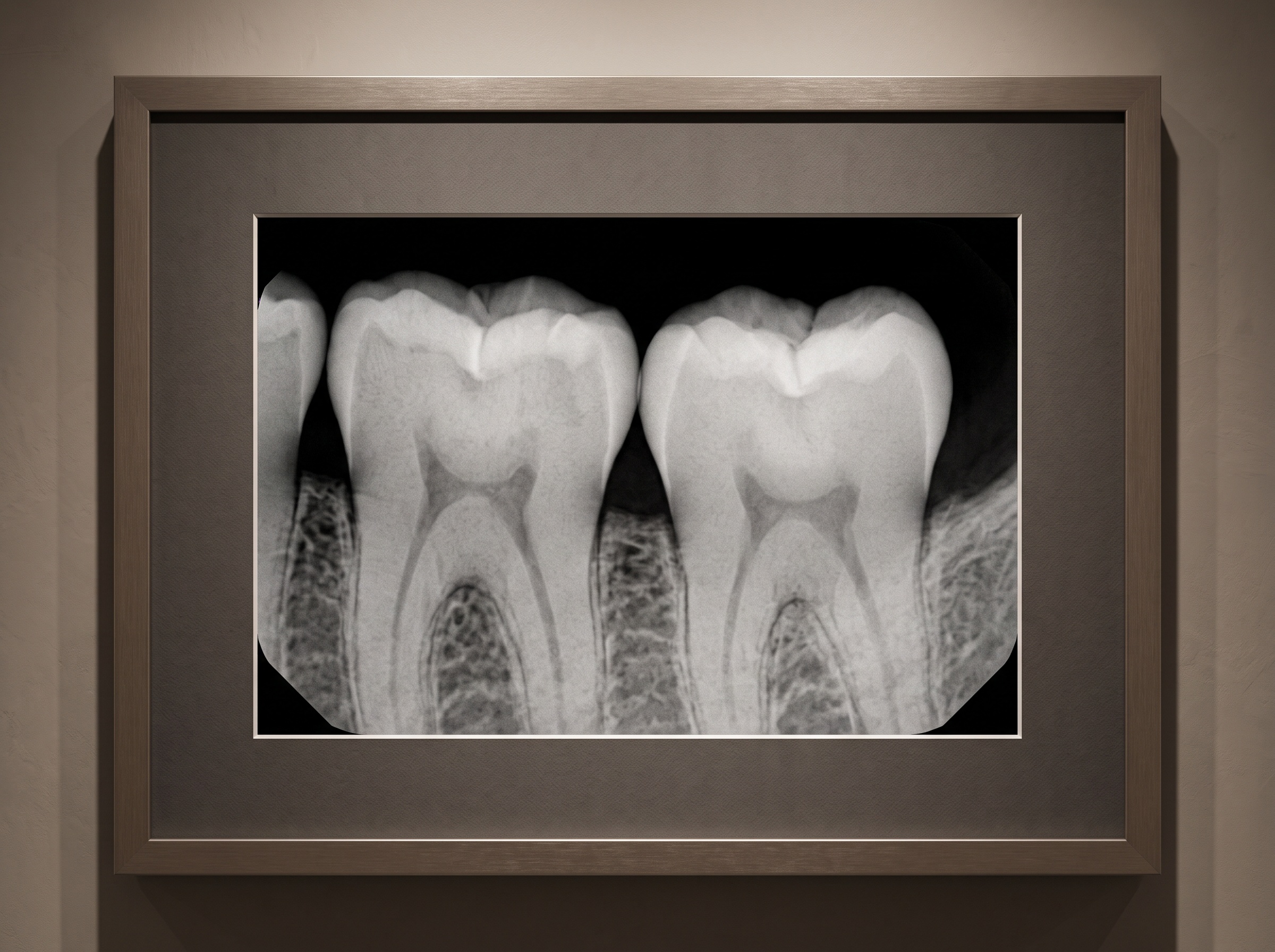 Close detail of a bitewing showing clean, open contacts between the molar teeth