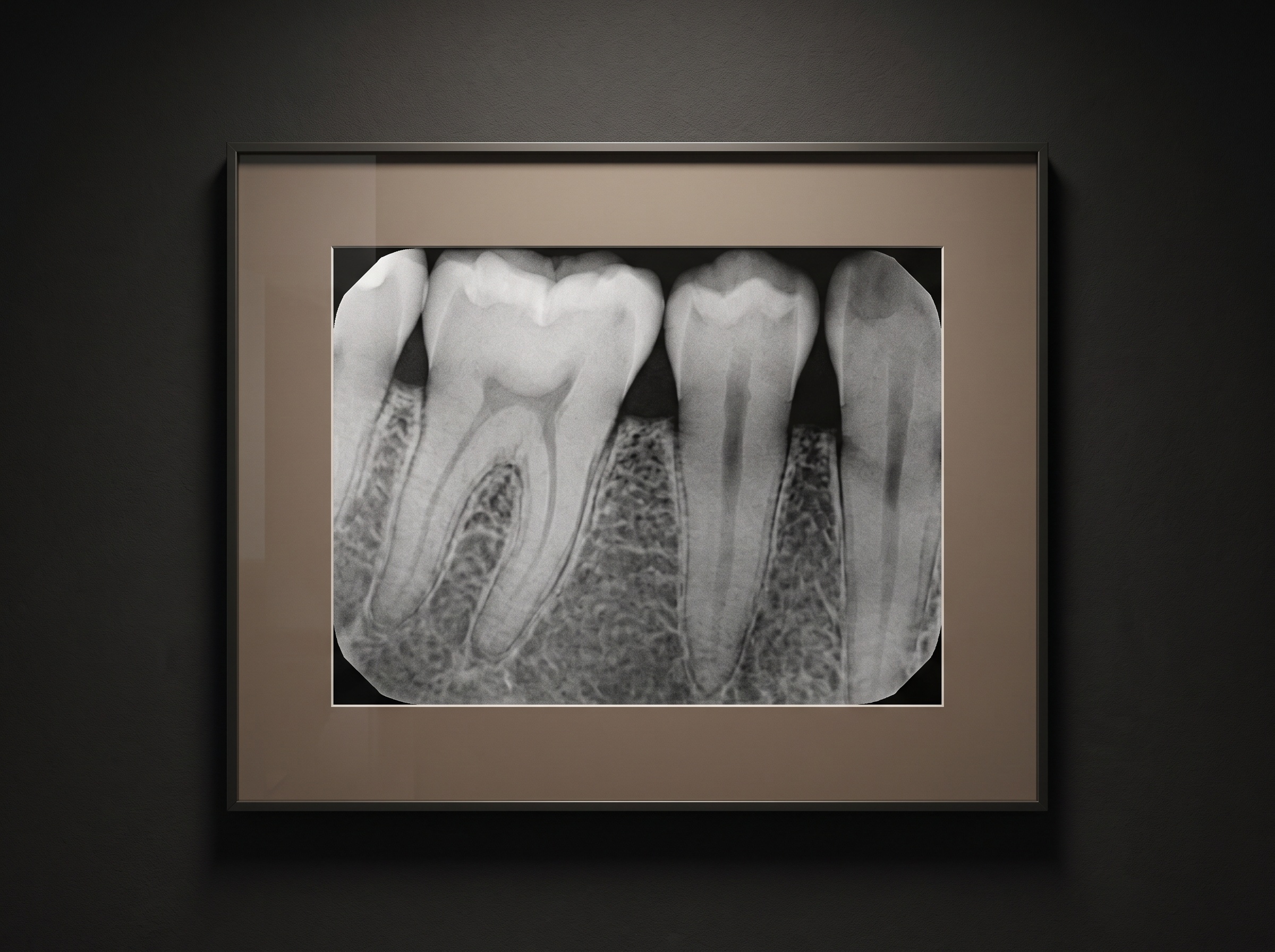 Detail of a bitewing showing the crestal bone level and fine bony architecture between teeth
