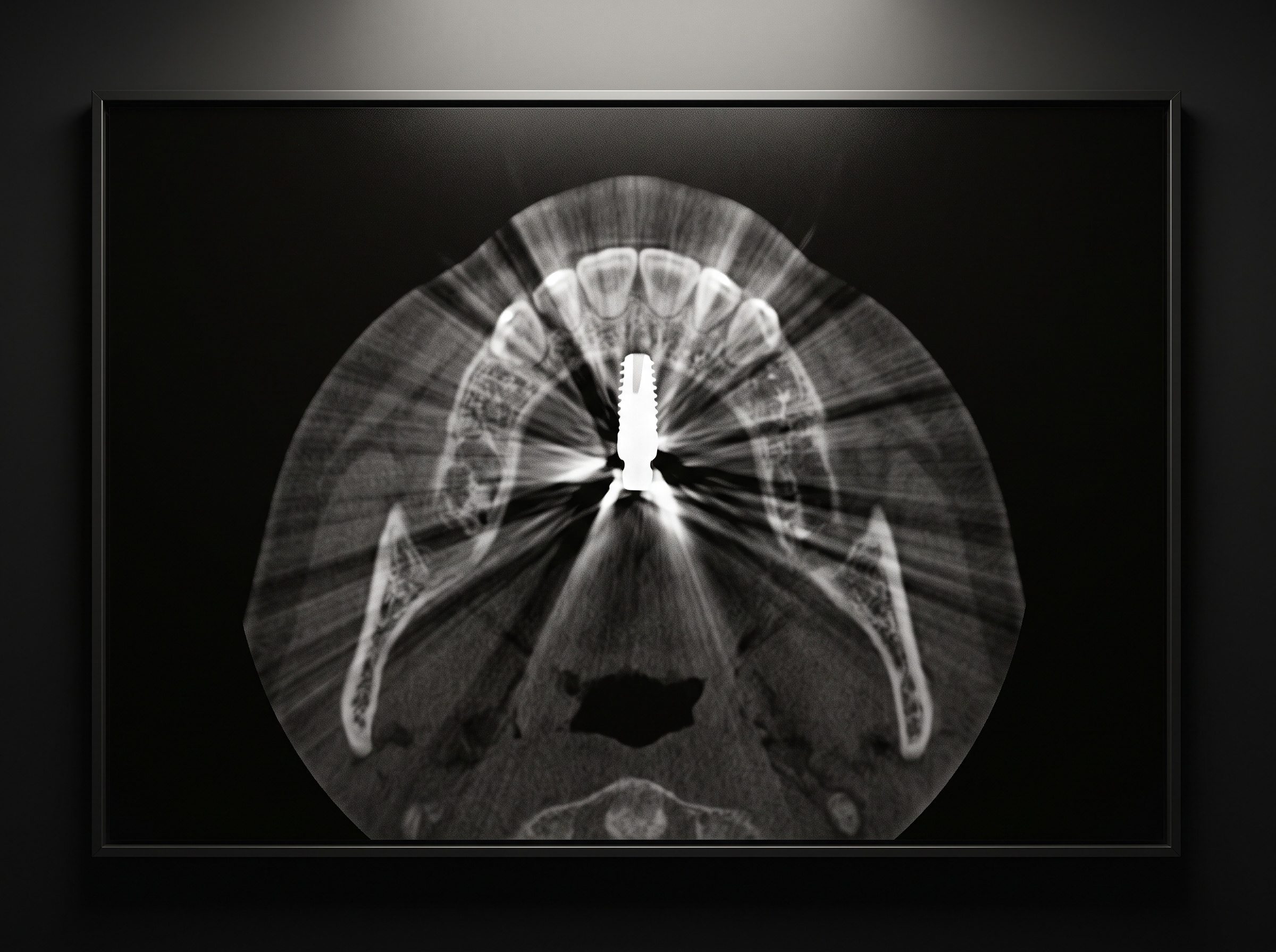 An axial CT slice with bright and dark streaks radiating from a metal dental implant