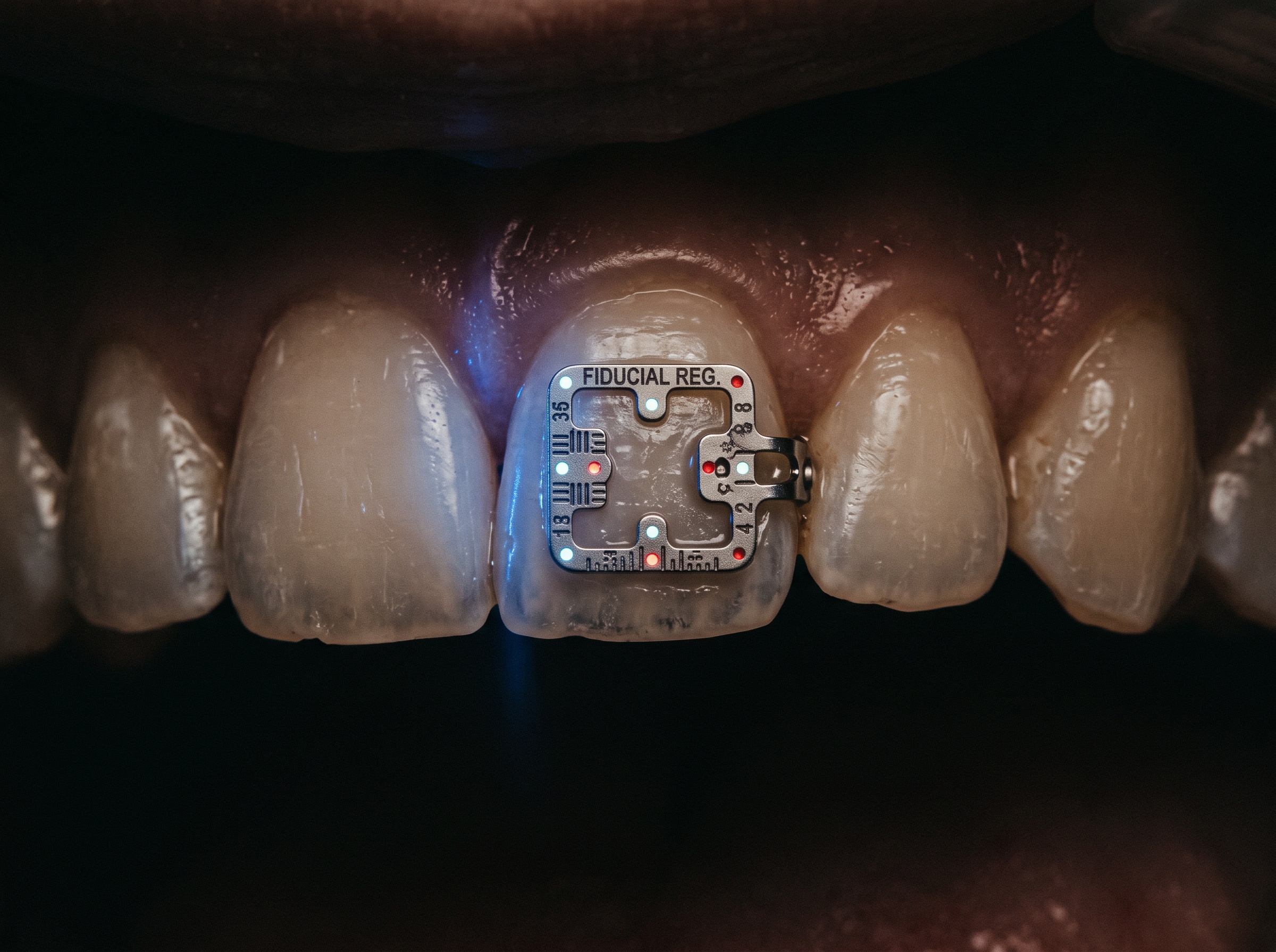 A small fiducial marker frame clipped to the teeth, used to register the virtual scan to the real patient