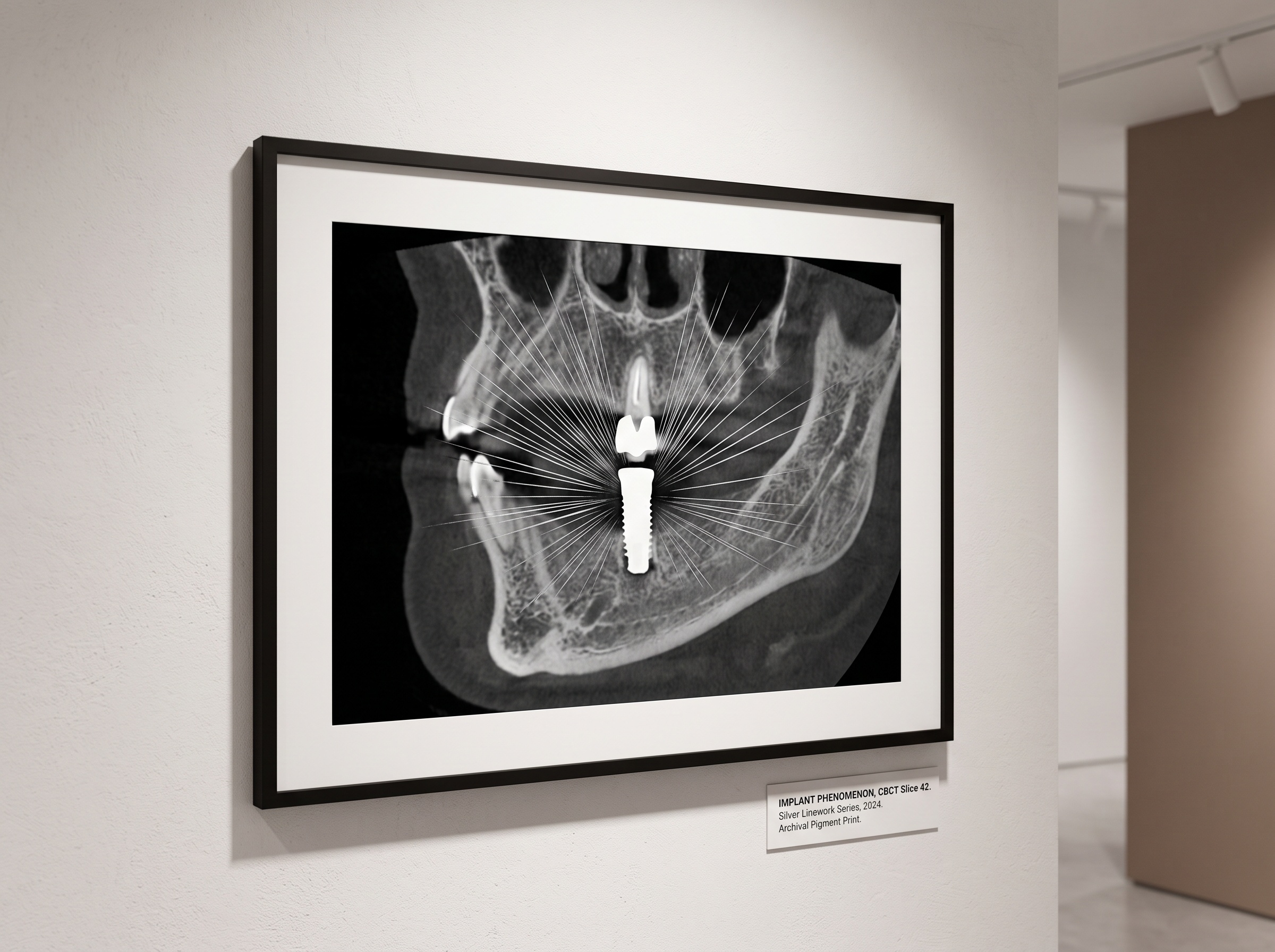 A framed CBCT slice showing streak artifacts radiating from a metal dental implant