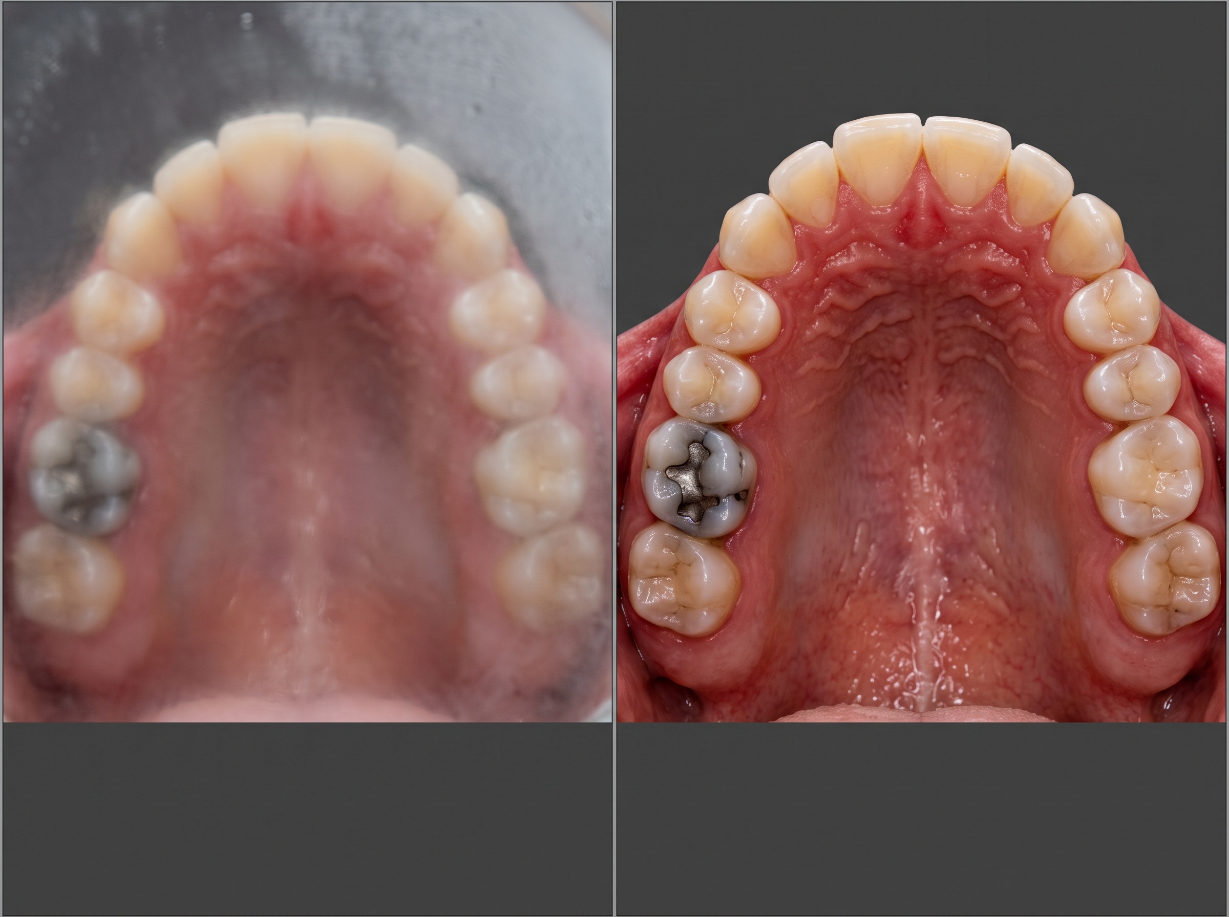 Two occlusal photographs compared, one fogged and one clear