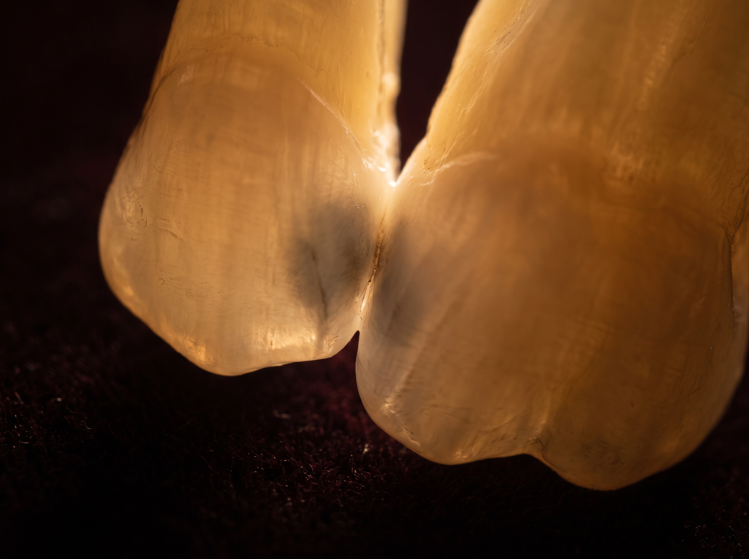 A transilluminated premolar with a dark interproximal shadow between teeth